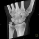 Fracture of scaphoid bone, dislocation of pisiform bone, abruption of lunate: CT - Computed tomography